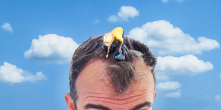 Passei anos tentando salvar meu cabelo antes de fazer um transplante